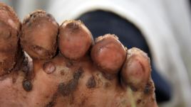 Kenyan organization focuses on scourge of jiggers