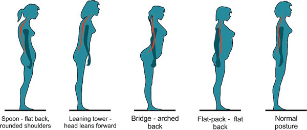你是“勺形”還是“橋形”？站姿決定背痛與否